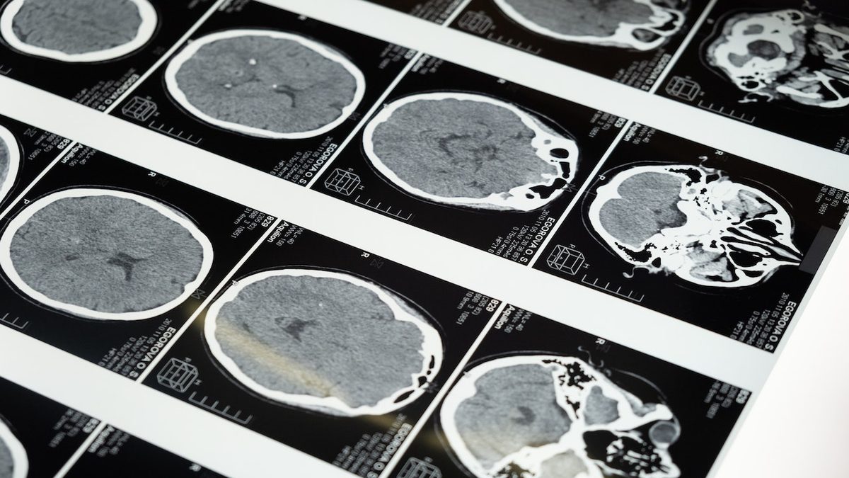 How Does a Fixed Mindset Affect Our Trading?